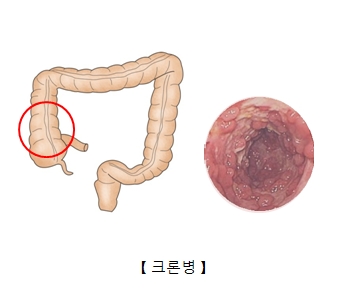 크론병