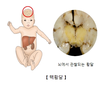 핵황달