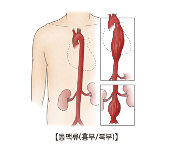 흉부대동맥류