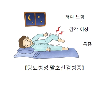 당뇨병성 말초신경병증