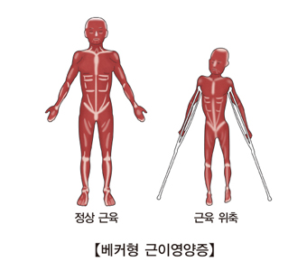 베커형 근이영양증