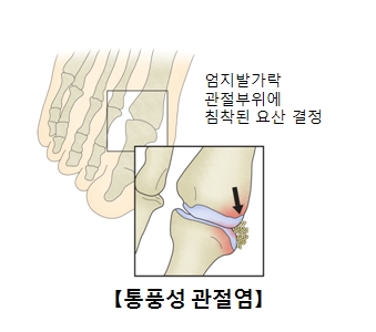 통풍성 관절염