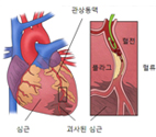 급성 심근경색증