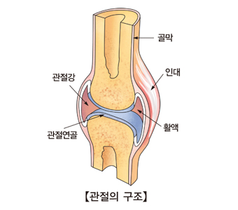 관절염