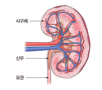 사구체신염