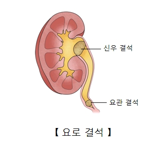 요로 결석증