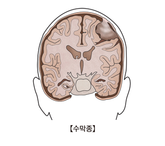 수막종