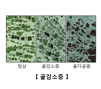 골감소증