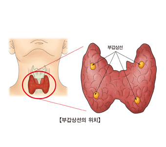 부갑상선암