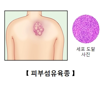 피부섬유육종