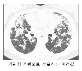 원인불명 신종 폐질환