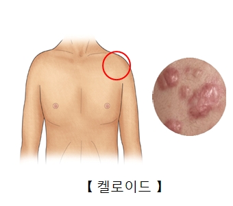 켈로이드