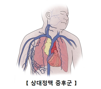 상대정맥 증후군