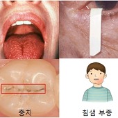 쇼그렌증후군