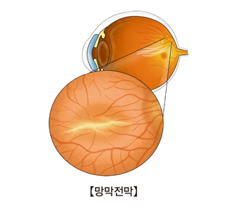 망막전막