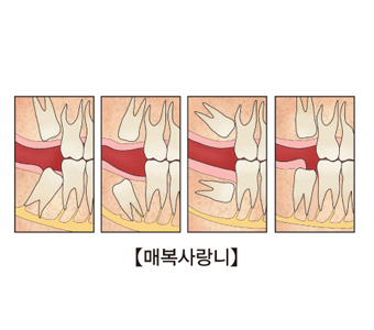 매복사랑니