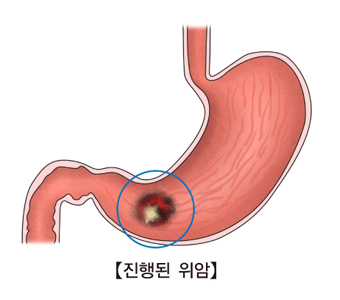 진행성 위암