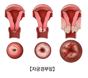 자궁경부암