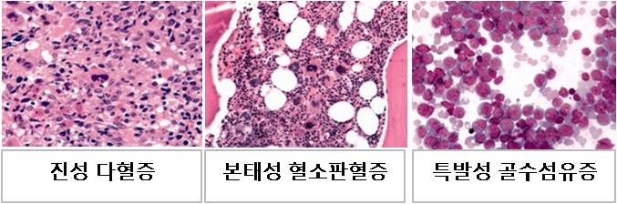 골수증식성 신생물