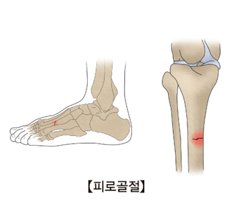 피로 골절