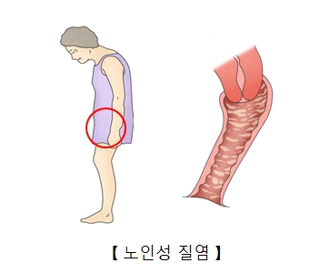 노인성 질염