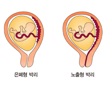 태반 조기 박리