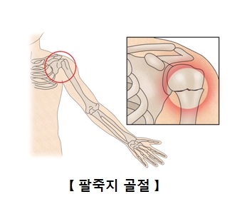 팔죽지 골절