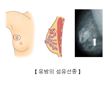 유방의 섬유선종