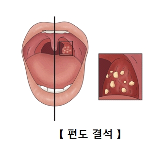 편도결석