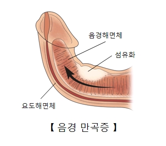 음경만곡증