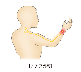 신경근병증