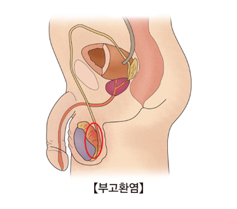 부고환염