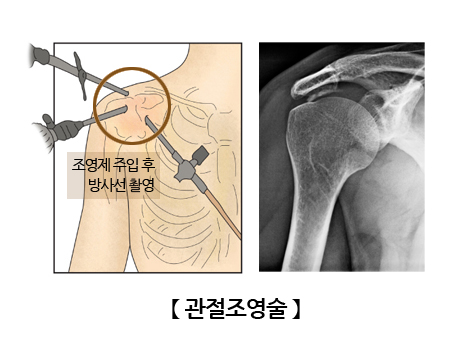 관절조영술