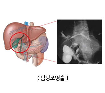 담낭조영술