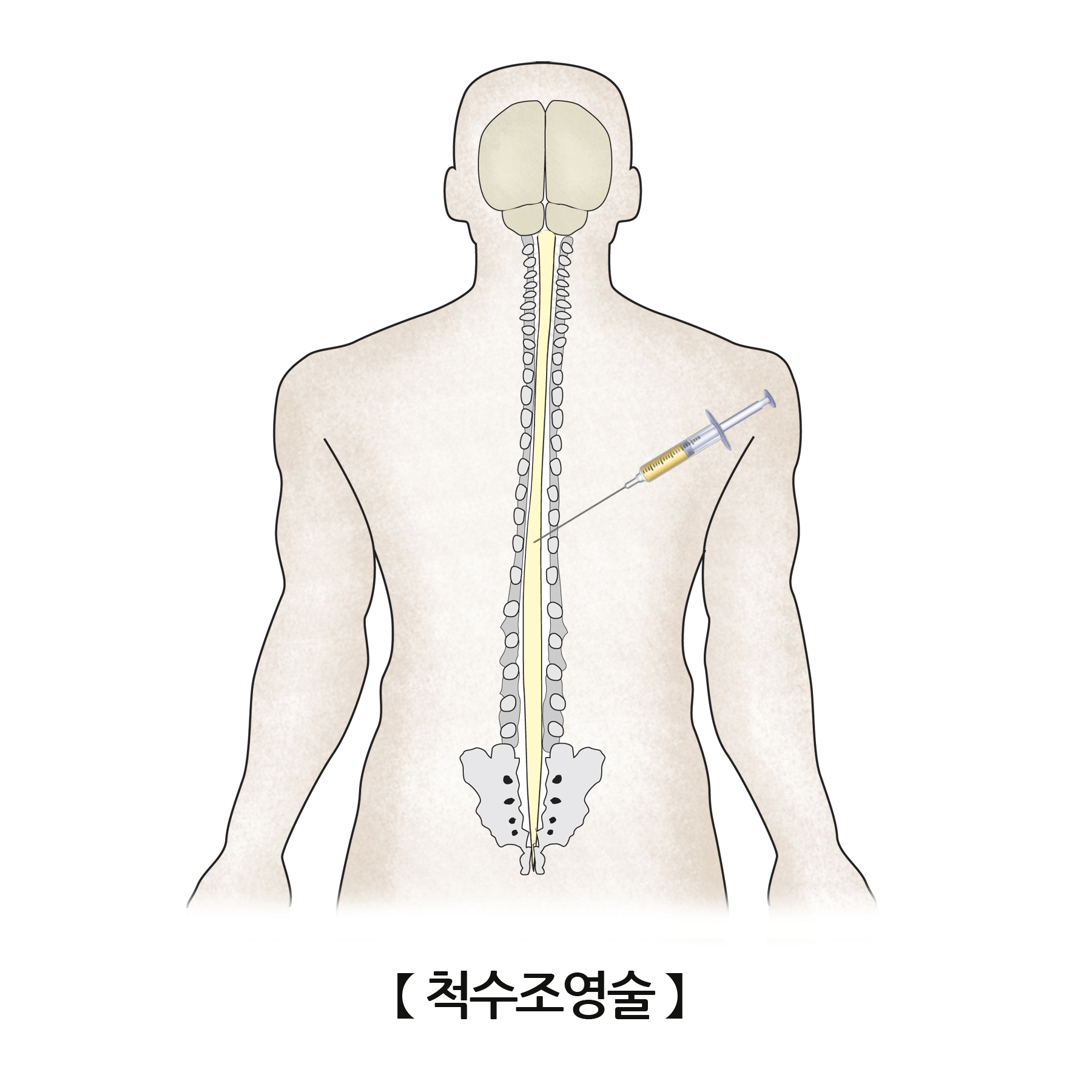 척수조영술