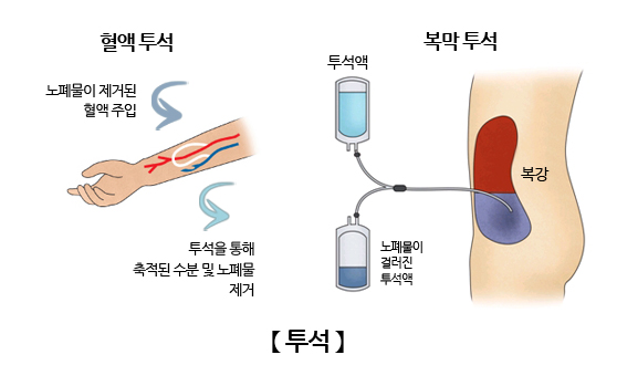 투석