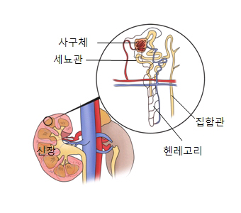 사구체